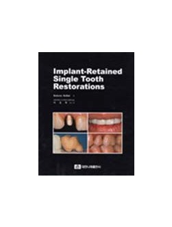 Implant-Retained Single Tooth Restorations