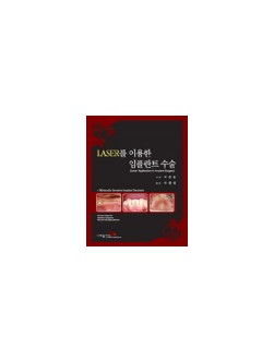 LASER를 이용한 임플란트 수술(Laser Application In Implant Surgery)