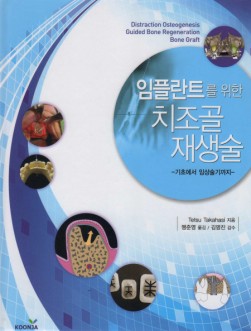 임플란트를 위한 치조골 재생술