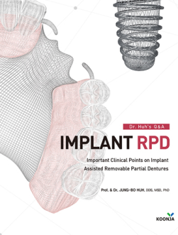 Dr. Huh`s Q&A IMPLANT RPD