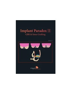 Implant Paradox I GBR & Sinus Grafting