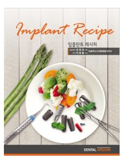 임플란트 레시피 (Implant Recipe)