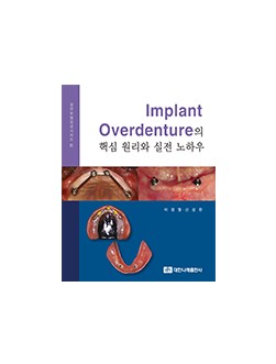 (실전보철임상시리즈 II) Implant Overdenture의 핵심 원리와 실전 노하우     
