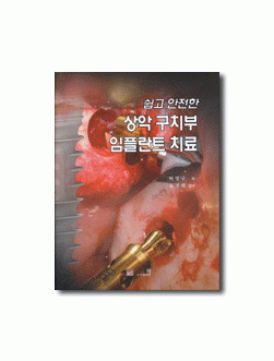 쉽고 안전한 상악 구치부 임플란트 치료