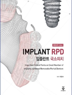 허중보의 Q&A 임플란트 국소의치 (Implant RPD)