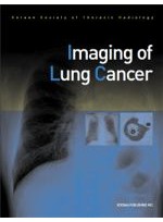 Imaging of Lung Cancer(군자)