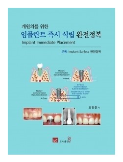 개원의를 위한 임플란트 즉시 식립 완전정복