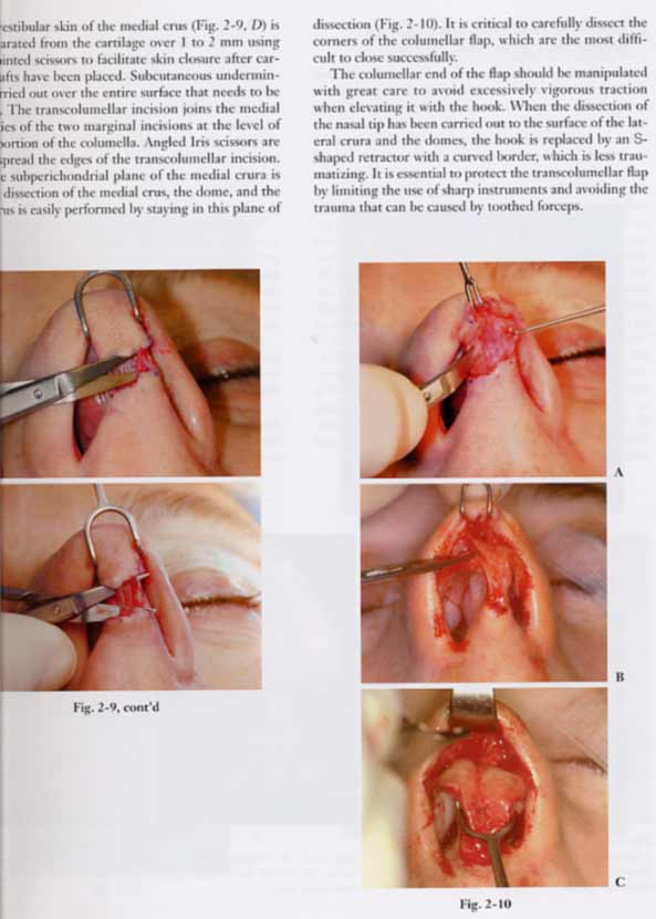 Atlas of Rhinoplasty : Open and Endonasal Approaches