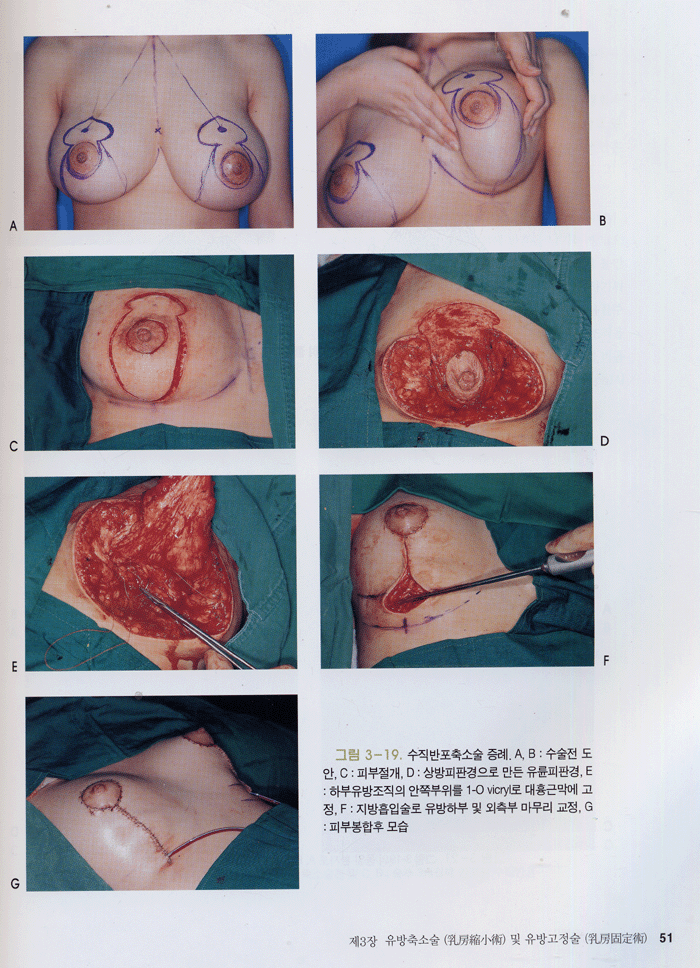 유방 성형외과학