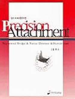 심미 치과보철을 위한 Precision Attachment