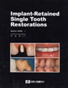 Implant-Retained Single Tooth Restorations