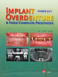 IMPLANT OVERDENTURE & Fixed Complete Prosthesis