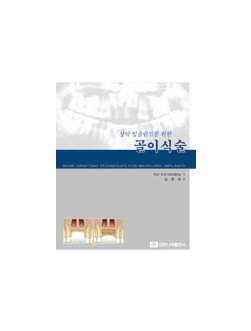 상악 임플란트를 위한 골이식술