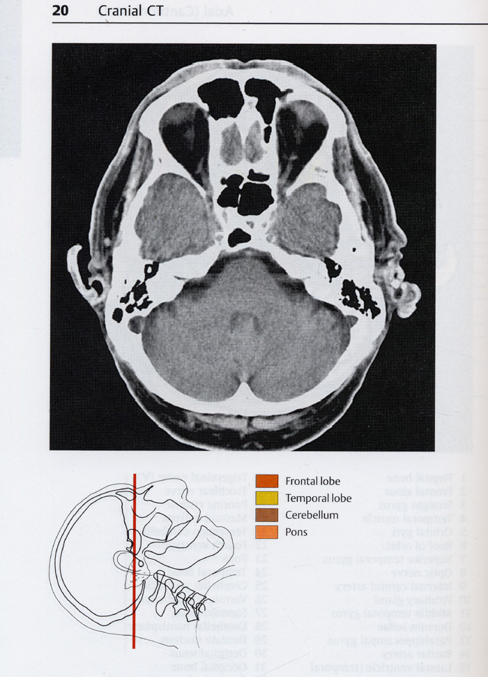 Pocket Atlas of Sectional AnatomyComputed Tomography and Magnetic Resonance Imaging Volume I: Head and Neck 3th