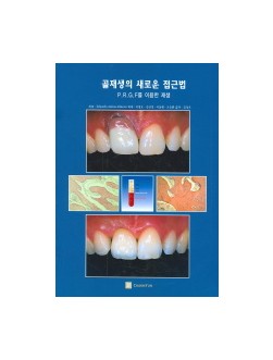 골재생의 새로운 접근법 (P.R.G.F를 이용한 재생)
