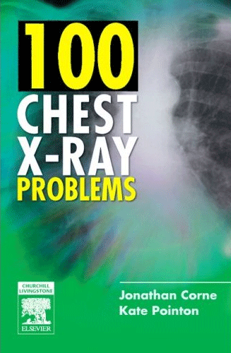 100 Chest X-Ray Problems