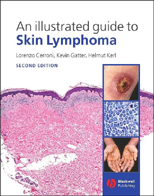 An Illustrated Guide to Skin Lymphoma, 2/e
