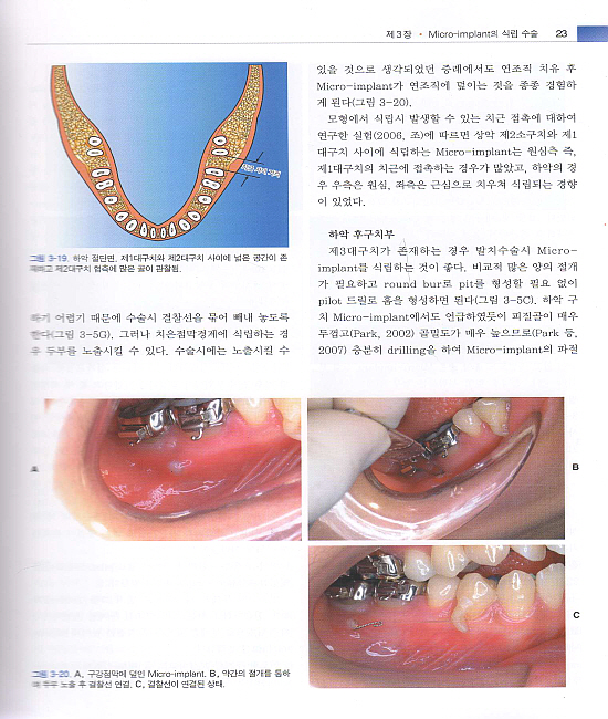 Micro-implant를 이용한 교정치료 (제2판)