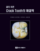 골치 아픈 Crack Tooth의 해결책[부록포함]