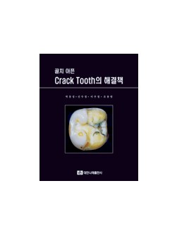 골치 아픈 Crack Tooth의 해결책[부록포함]