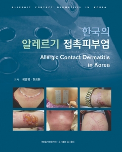 한국의 알레르기 접촉피부염