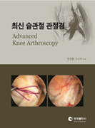 최신 슬관절 관절경 (Advanced Knee Arthroscopy)