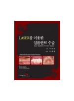 LASER를 이용한 임플란트 수술(Laser Application In Implant Surgery)