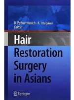 Hair Restoration Surgery in Asians
