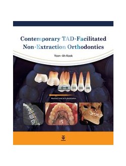 Contemporary TAD-Facilitated Non-Extraction Orthodontics