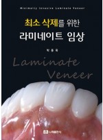 최소 삭제를 위한 라미네이트 임상
