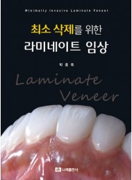 최소 삭제를 위한 라미네이트 임상