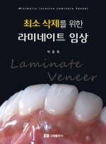 최소 삭제를 위한 라미네이트 임상