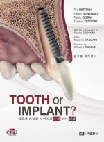TOOTH or IMPLANT? - 심하게 손상된 자연치의 수복 또는 대체