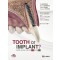 TOOTH or IMPLANT? - 심하게 손상된 자연치의 수복 또는 대체