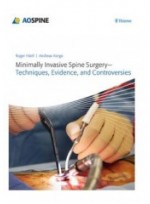 Minimally Invasive Spine Surgery: Techniques, Evidence, and Controversies 