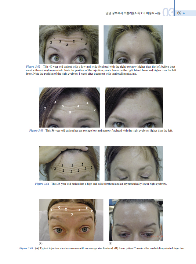 보톡스 얼굴해부학과 동영상 실기,2판 (마이크로 보톡스를 이용한 안면·종아리 퇴축술·다한증치료·피부재생술)