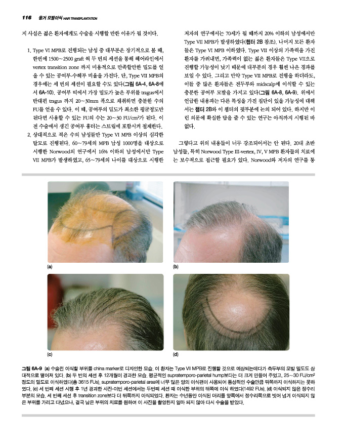 Unger's 모발이식 Hair Transplantation (DVD포함)