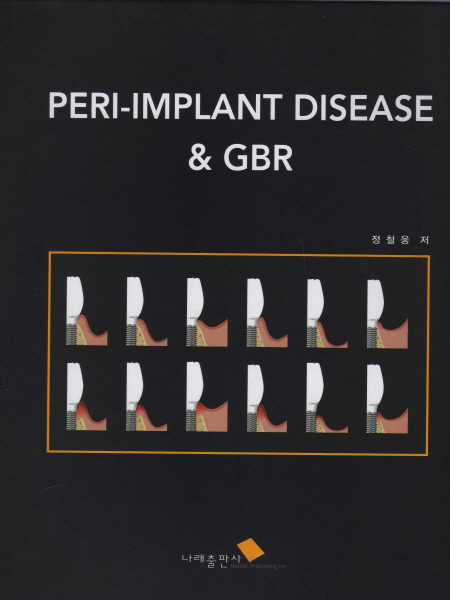 PERI-IMPLANT DISEASE & GBR