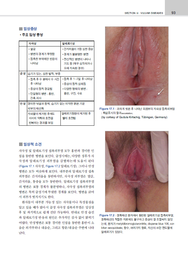 부인과 피부과학:진료지침-Gynecologic Dermatology   